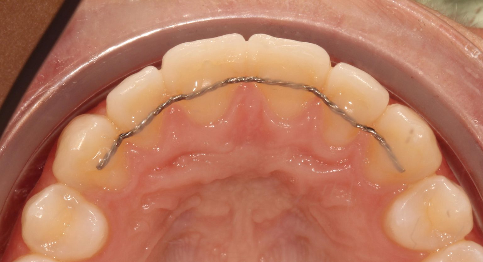 Retentie apparatuur Orthodontie op IJburg